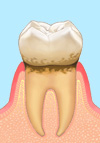 歯周病治療