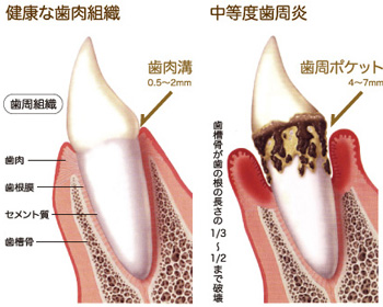 歯周病進行