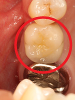 インプラント症例4-2