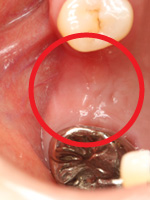 インプラント症例4-1