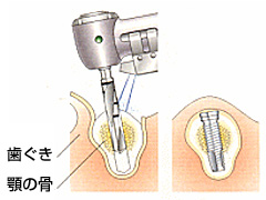 大森東歯科　インプラント